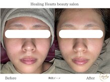 ヒーリングハーツ(Healing Hearts)/陶肌ピールで驚きの変化に！