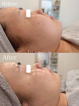 ルノン(Lunon)/毛穴洗浄ハイドロ×ララピール