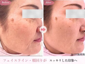 リジェネラティブセル メディカルサロン(Regenerative Cell Medical Salon)の写真/たるみ・もたつきにアプローチ◎疲れ顔をリフトアップ！フェイスラインに自信を♪年齢肌にエクソソーム導入