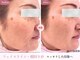 リジェネラティブセル メディカルサロン(Regenerative Cell Medical Salon)の写真/たるみ・もたつきにアプローチ◎疲れ顔をリフトアップ！フェイスラインに自信を♪年齢肌にエクソソーム導入