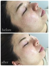 メイユール(MEILLEUR)/光フェイシャル1回