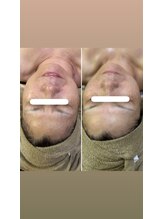 リテラ(Retera)/フェイシャル