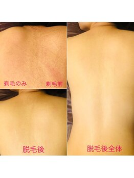 マックス 与野店(MAX)/背中脱毛☆ビフォアフ後ろ姿美人