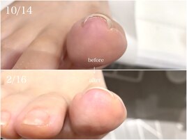 巻き爪補正　痛みが少ない！夏色