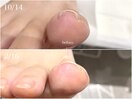 巻き爪補正　痛みが少ない！夏色