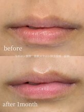 ラミパス(LAMIPAS)/ローマピンク　症例 リップ1ヶ月