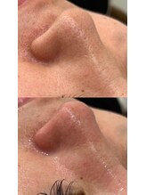 ラルガ 城野店(Raruga)/毛穴洗浄