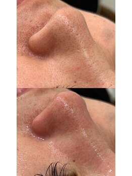 ラルガ 城野店(Raruga)/毛穴洗浄