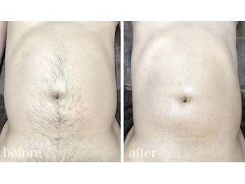 ホッコリ 府中店(HOKKORI)/【男女OK！】痛みの少ない脱毛