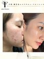 フローレンス(Florence)&nbsp;どんな肌悩みも気軽に聞いてね！得意中の得意です笑