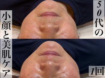 ビジュープラス 広島店(Bijou+)/【50代/たるみ、くすみケア】