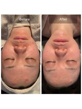 ルーチェ(Luce)/マイクロニードルピーリング