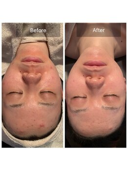 ルーチェ(Luce)/マイクロニードルピーリング