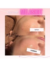 マヴィ くずは店(MavY.)/メラショット美容液