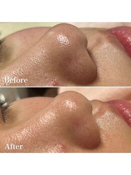 毛穴ケアをしたい