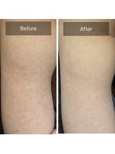 ルナート(Lunart)/ハーブピーリング【二の腕】