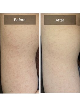 ルナート(Lunart)/ハーブピーリング【二の腕】