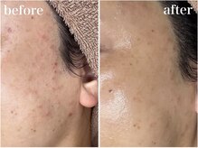 ホワイトアクア 錦糸町店(WHITE AQUA)/ララピール/毛穴/ニキビケア