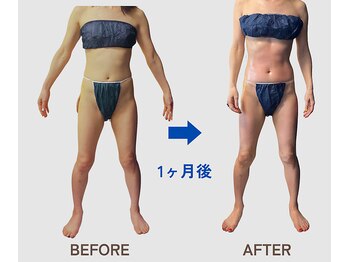 ネオボディ(Neo Body)/ビフォーアフター