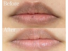 ライム 千葉(LIME)/ローマピンク｜黒ずみケア