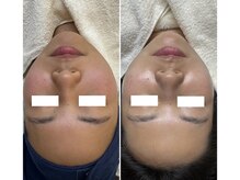 リノ(lino)/乾燥、赤みが気になる方に