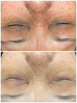 シーカラー 中野栄店(C.color)/集中シミケア