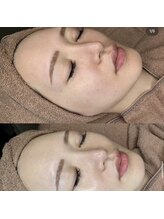 ブルーム(bloom)/ハーブピーリング/ララピール