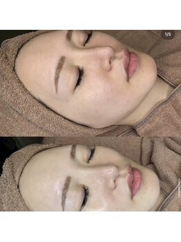 ブルーム(bloom)/ハーブピーリング/ララピール