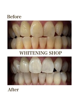 ホワイトニングショップ 安城店/【BeforeAfter】