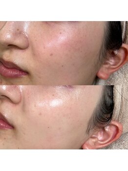 スイ 四条烏丸(SUI)/〇全顔シェービング