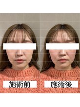 ヴィーライン 大阪梅田院(VeLine)/鍼灸／美容鍼／小顔／大阪／梅田