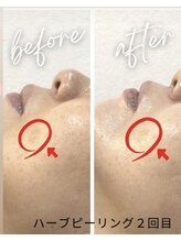 シエロ(Cielo)/シミケアもハーブピーリング◎