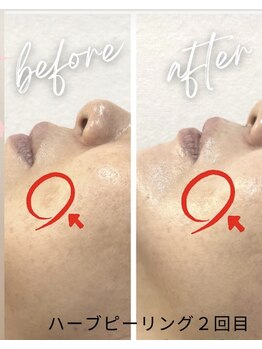 シエロ(Cielo)/シミケアもハーブピーリング◎