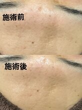 ツール(TOOL)/ハーブピーリング