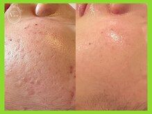 ヴィオール 名古屋栄店(VIOR)/肌質改善はハーブピーリング！