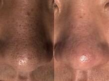 サラグランデ(Sara Grande)/メンズ毛穴エクストラクション