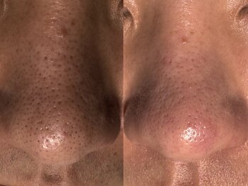 サラグランデ(Sara Grande)/メンズ毛穴エクストラクション