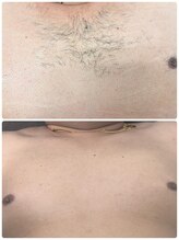 アイズ(I'Z)/胸脱毛