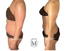 ミヨン(Miyong)/爆汗よもぎ蒸し×ラジオ波ボディ