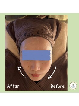 シオン(Sion)/お顔Before/After