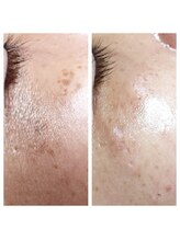 アリアンド(ari.and)/ララピール　症例写真