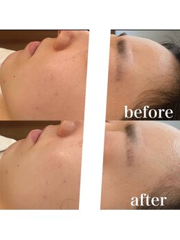 ビジュープラス 松本店(Bijou+)/ハーブピーリング