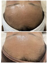 ビュー(Beau)/スキンケアWAX脱毛