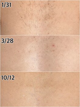 ルシャトン(Le Chaton)/胸毛脱毛