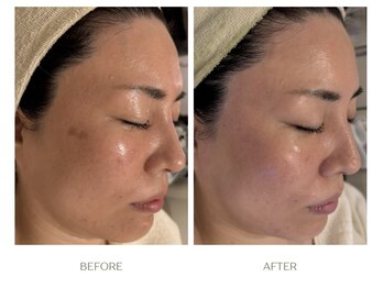 ラシェプリズ(LACHER PRISE)/シミケア・改善例