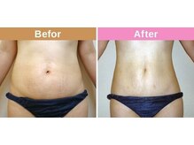 メディカル整体院/最新ハイパーナイフ7/痩身