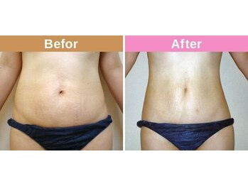 メディカル整体院/最新ハイパーナイフ7/痩身