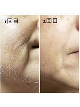 ジーニー(Genie)/リベル　ハーブピーリング