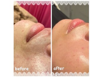 スピード美人 銀座店/お肌が変わるハーブピーリング