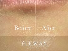 チャームズ(CHARM'S)/気になる口元の産毛も徹底除去☆